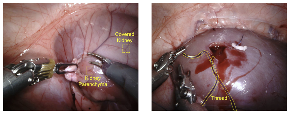 Surgical Scene Segmentation by Transformer with Asymmetric Feature Enhancement