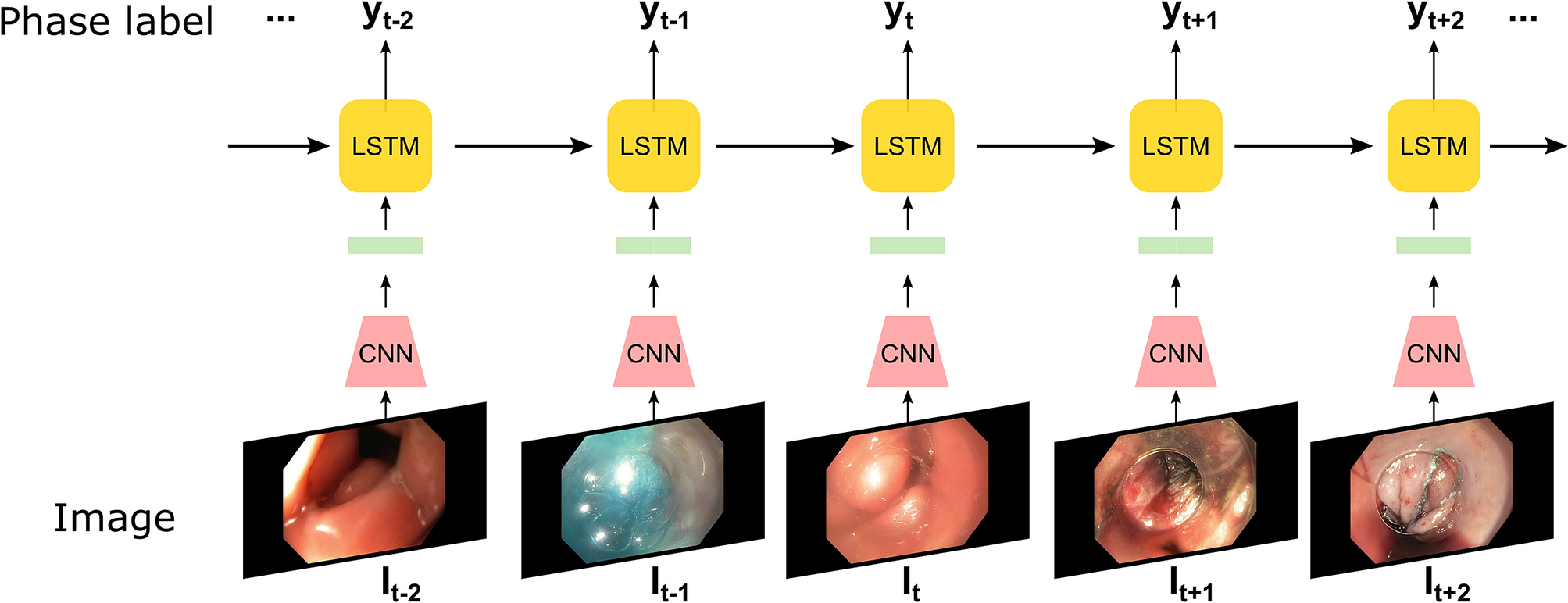 Automated Operative Phase Identification in Peroral Endoscopic Myotomy