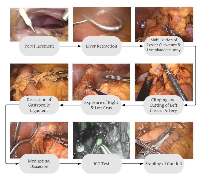 TEsoNet: Knowledge Transfer from laparoscopic Sleeve Gastrectomy to the Ivor-Lewis Esophagectomy